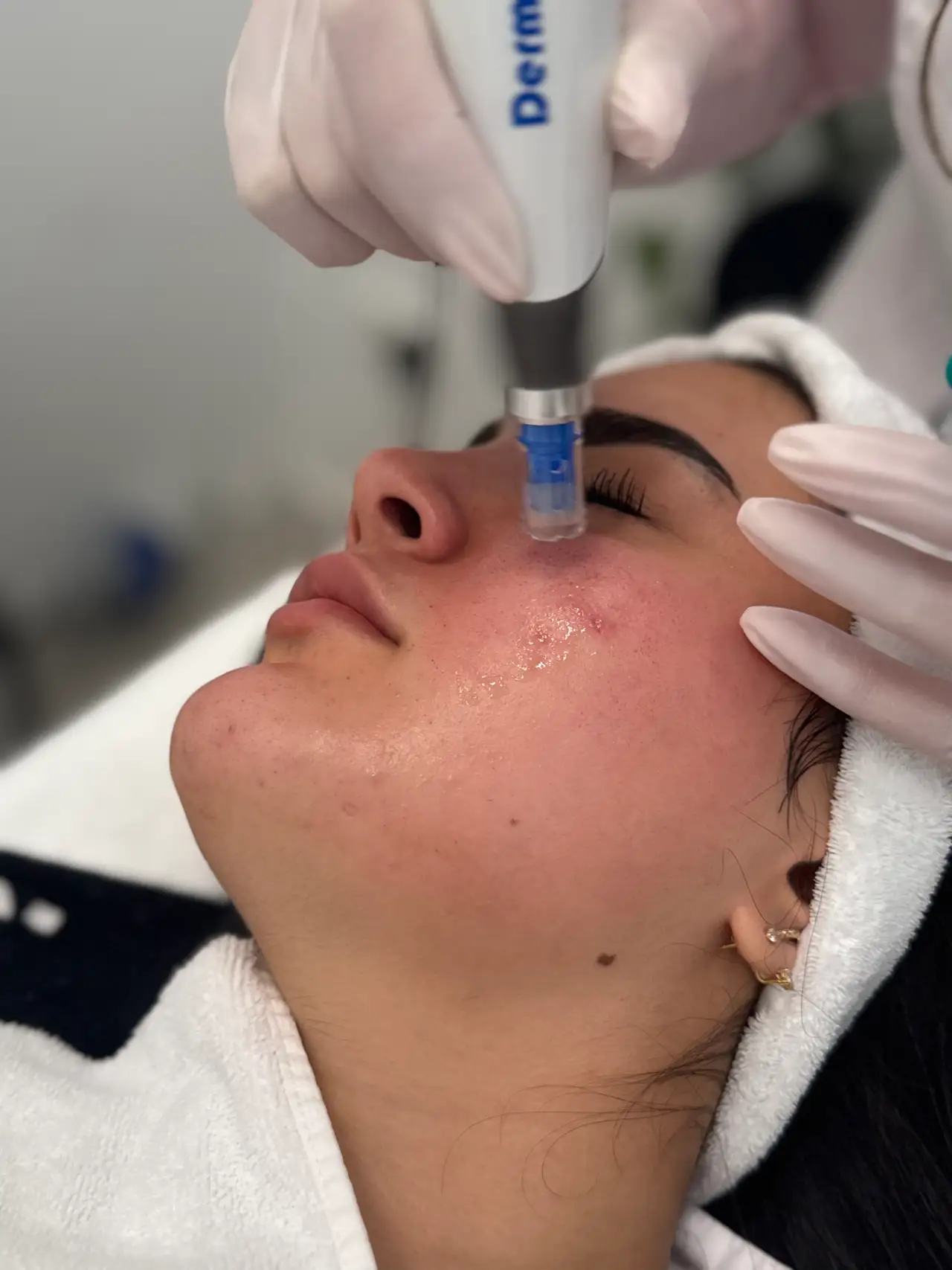 Foto tijdens Microneedling behandeling in Rotterdam