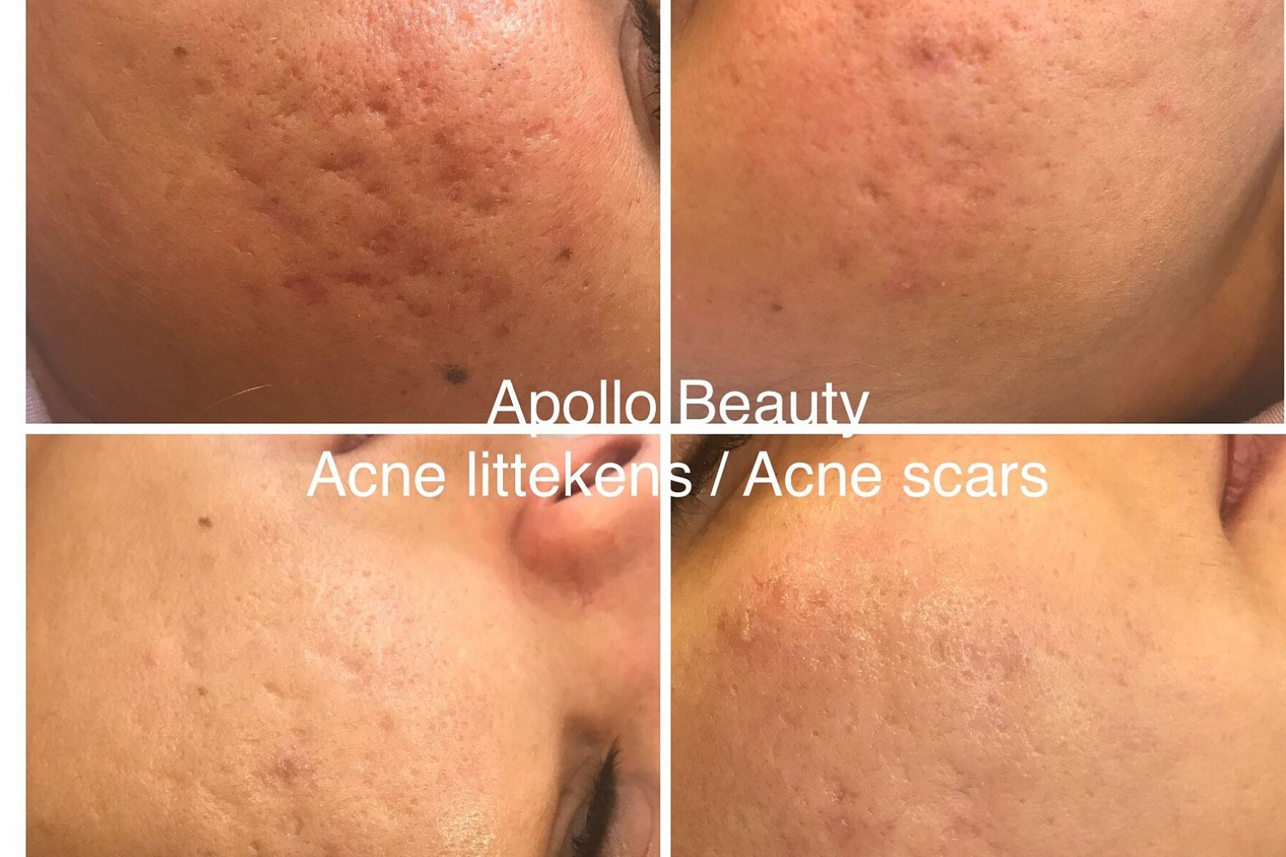 Voor En Na Foto Fractional Laserbehandeling Acne 2