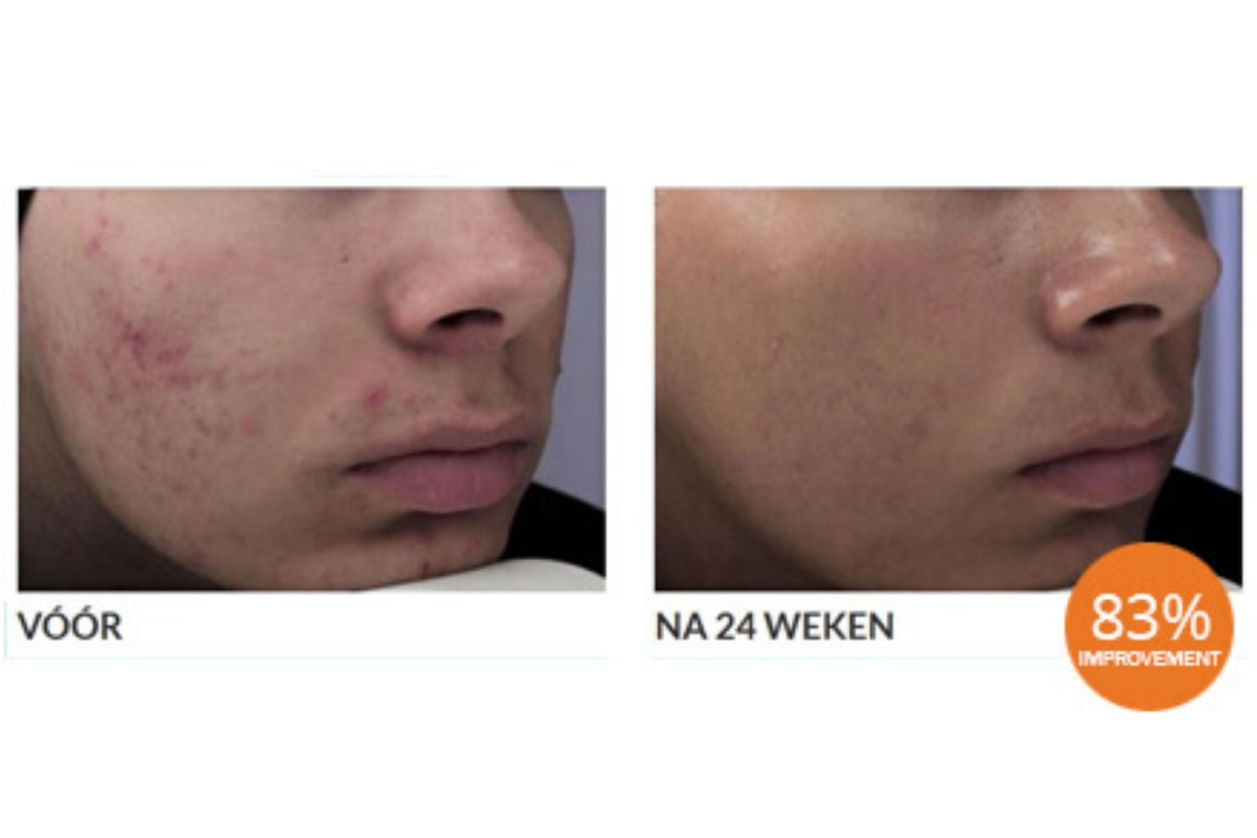 Voor En Na Foto Sebacia Acne 1