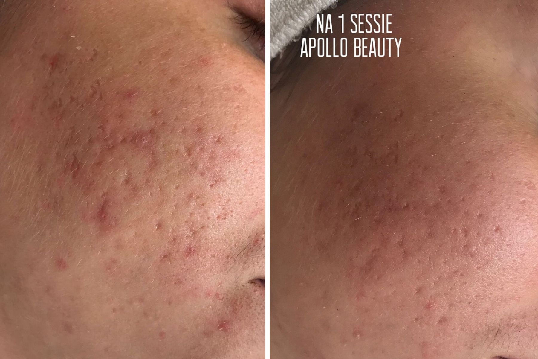Voor En Na Foto Fractional Laserbehandeling Acne 1