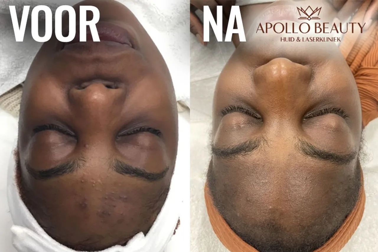 Chemische peeling voor en na foto