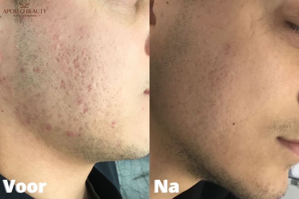 Apollo Fractional LASER Acne Voor Na