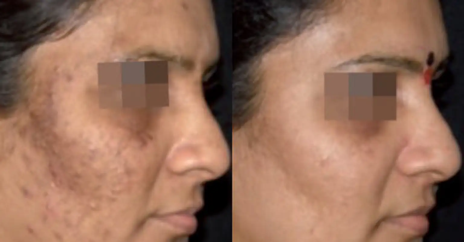 Cosmelan behandeling in Rotterdam